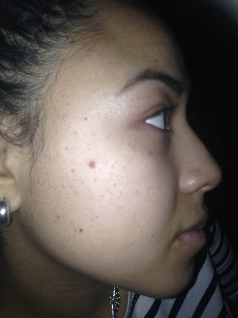 pictures of skin tags and moles
