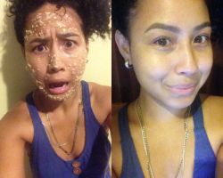 How to Get Rid of Acne Fast and Naturally- Top Method of All Time!